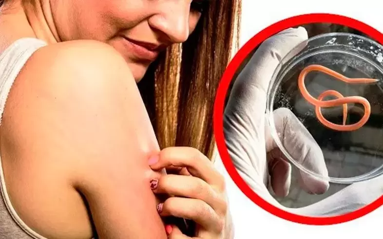 сърбеж и дразнене поради паразити в тялото