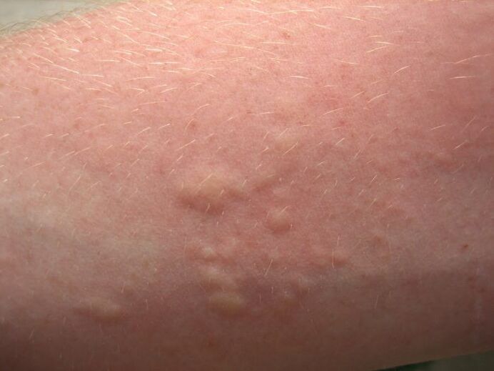 сърбящи алергични кожни обриви могат да бъдат симптоми на аскаридоза