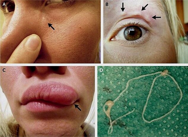 Основните прояви на дирофилариозата по лицето