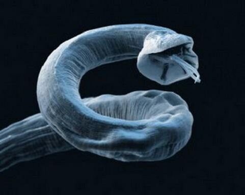червей от човешкото тяло как да премахнете