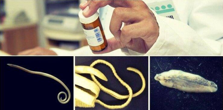 Видове червеи и медицински методи за отстраняването им